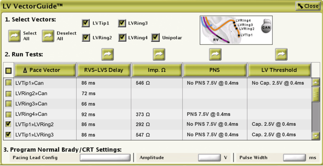 Where To Pace | SmartCRT - Boston Scientific